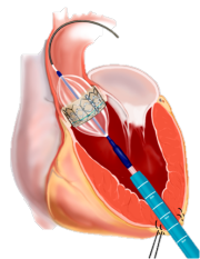 Implantat 1