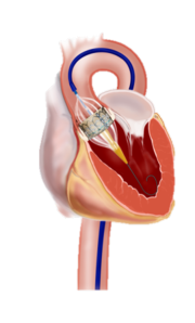 Implantat 2